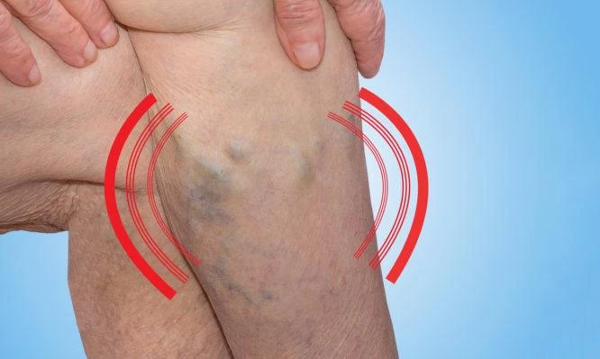 Φλεβική θρόμβωση: Ένας «σιωπηλός δολοφόνος» – Ποια τα πρώιμα συμπτώματα